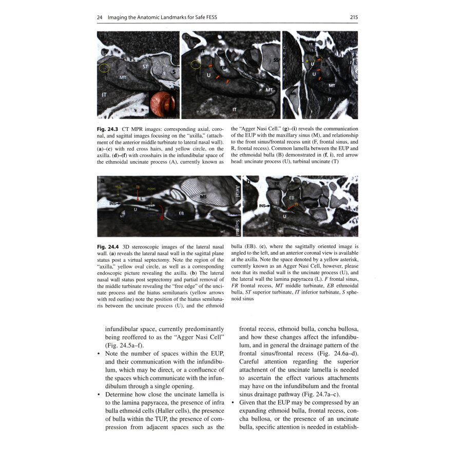 Sample pages of Chronic Rhinosinusitis: The Mucosal Concept (ISBN:9787117342193)