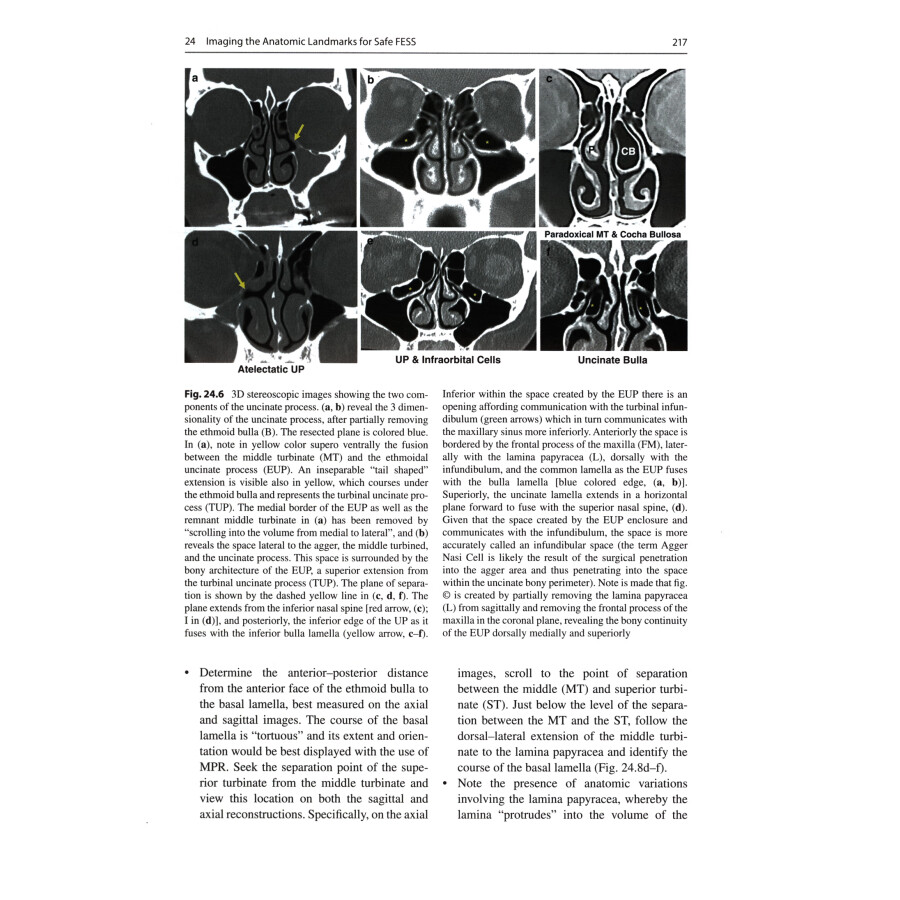 Sample pages of Chronic Rhinosinusitis: The Mucosal Concept (ISBN:9787117342193)