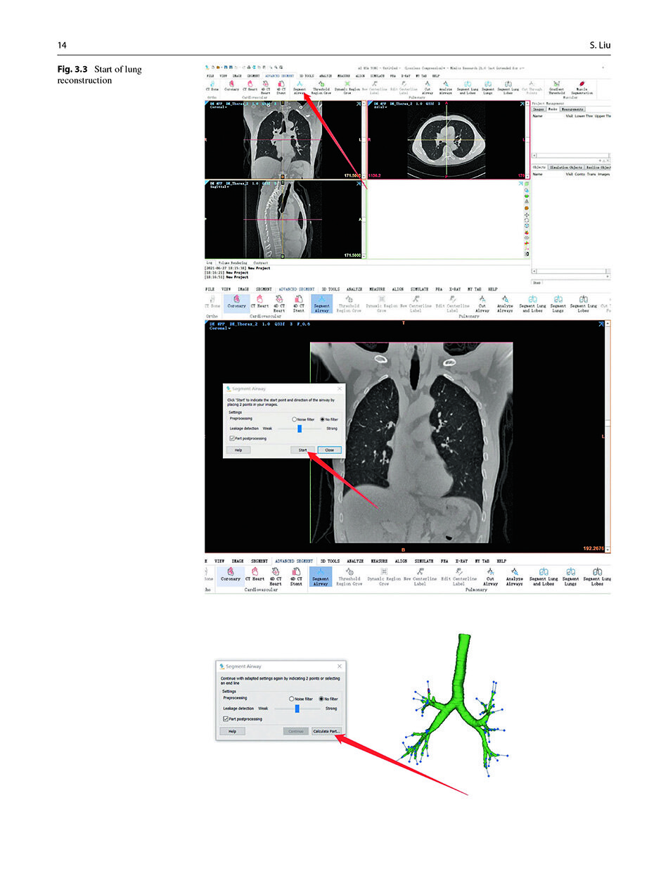 Sample pages of Segmentectomy for Early-Stage Lung Cancer 3D Navigation (ISBN:9787523508152)