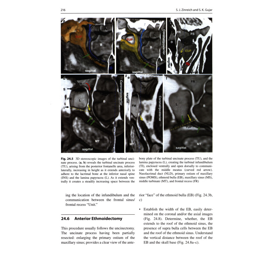 Sample pages of Chronic Rhinosinusitis: The Mucosal Concept (ISBN:9787117342193)