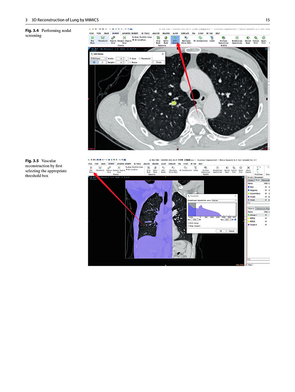 Sample pages of Segmentectomy for Early-Stage Lung Cancer 3D Navigation (ISBN:9787523508152)